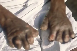 Maharashtra Health News: कुष्ठ रोगी खोज अभियान जिले में 17 नवंबर से 2 दिसंबर तक घर-घर सर्वे, शीघ्र निदान और उपचार पर विशेष ज़ोर