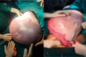 नागपुर में 22 वर्षीय युवती के पेट से 14 किलो का ट्यूमर निकाला गया, डॉक्टरों ने बचाई भविष्य की मां बनने की क्षमता
